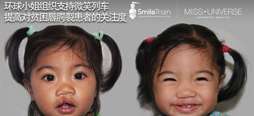 环球小姐组织支持微笑列车提高对贫困唇腭裂患者的关注度